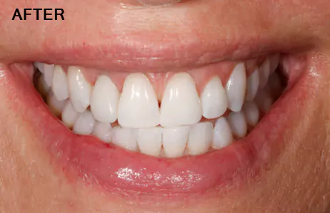 After Dental Implant Treatment at Impressionz Dental Care