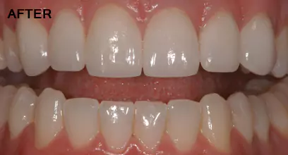After Dental Venners Process at Impressionz Dental Care