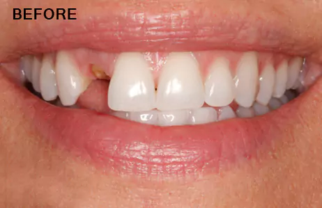 Before Dental Implant Treatment