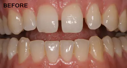 Before Dental Veneers Process