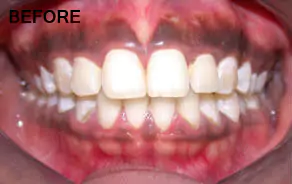 Before Gum Depigmentation
