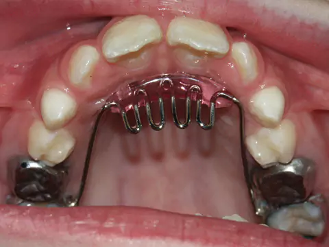 Habit Breaking Appliances at Impressionz Dental Care