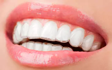 Invisalign Braces Treatment in Borivali West