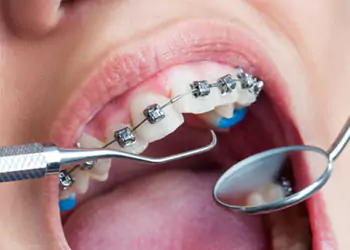 Invisalign Treatment in Borivali West