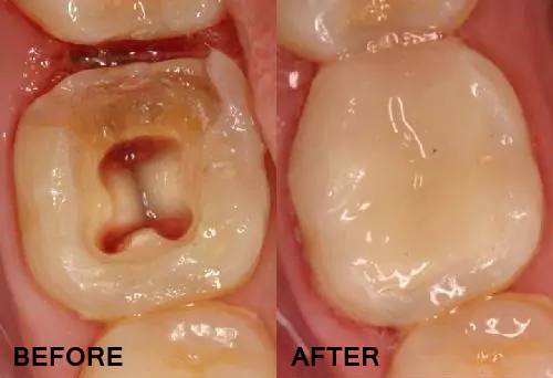 Pulpectomy Treatment in Borivali West